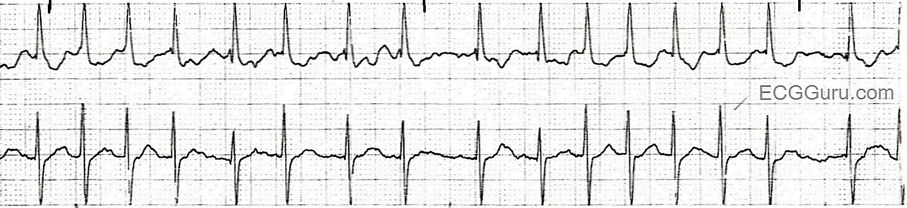 ECG Basics: Atrial Fibrillation With a Rapid Ventricular Response ...